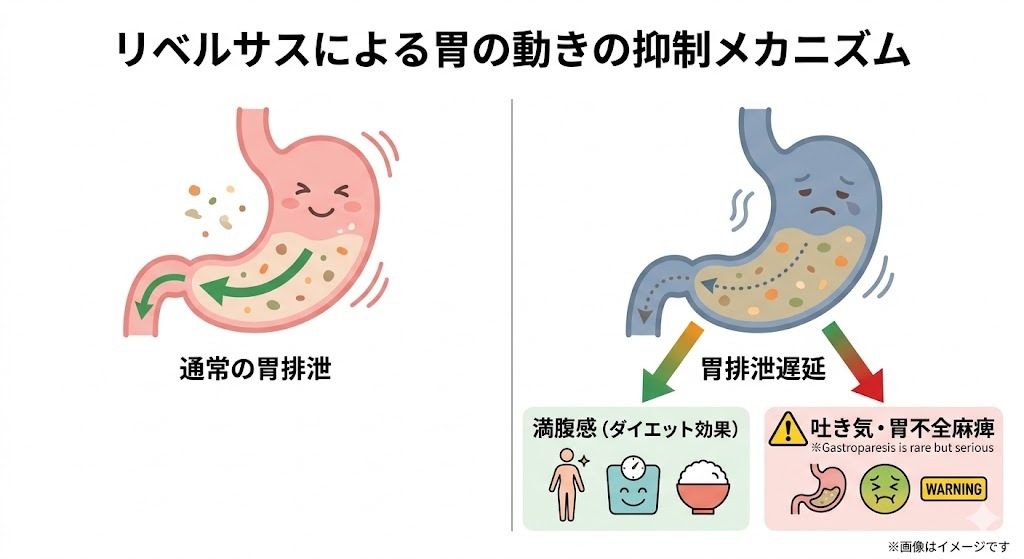 リベルサスによる胃の動きの抑制メカニズム。通常の胃排泄と、胃排泄遅延による「満腹感(ダイエット効果)」および「吐き気・胃不全麻痺」のリスクを示す比較イラスト